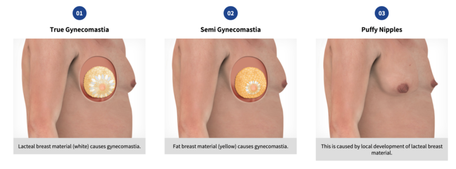 Boston gynecomastia specialists Types of Gynecomastia