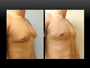 Surgical treatment of puffy nipples