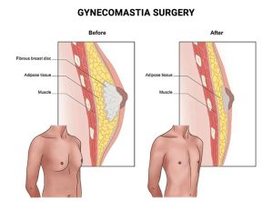 Gynecomastia Surgery in Boston