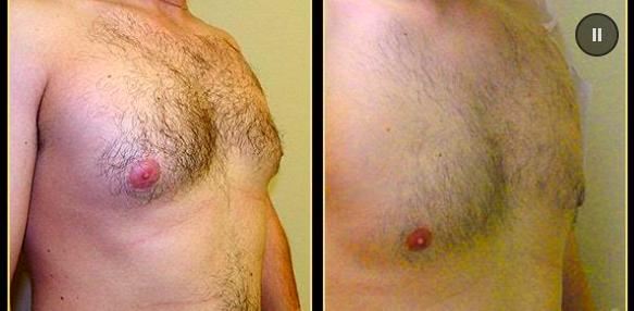 Boston Gynecomastia Specialists result