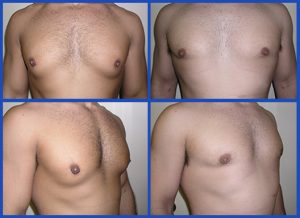 Gynecomastia treatment in body builders