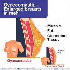 Gynecomastia