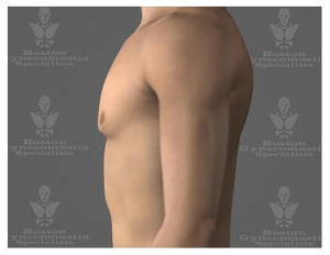 Gynecomastia