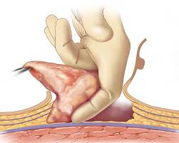 Gynecomastia