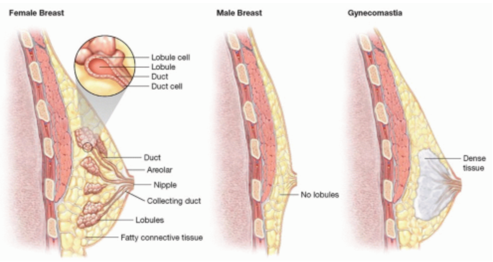 Gynecomastia explained