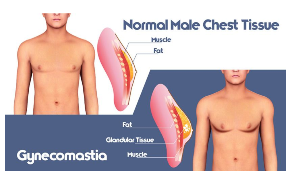 Gynecomastia chest tissue