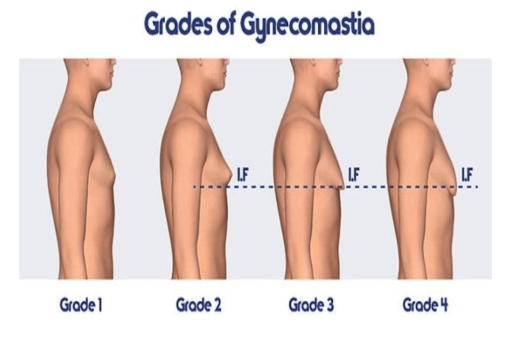 Grades of Gynecomastia