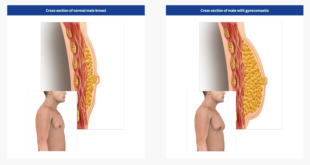 Gynecomastia cross section