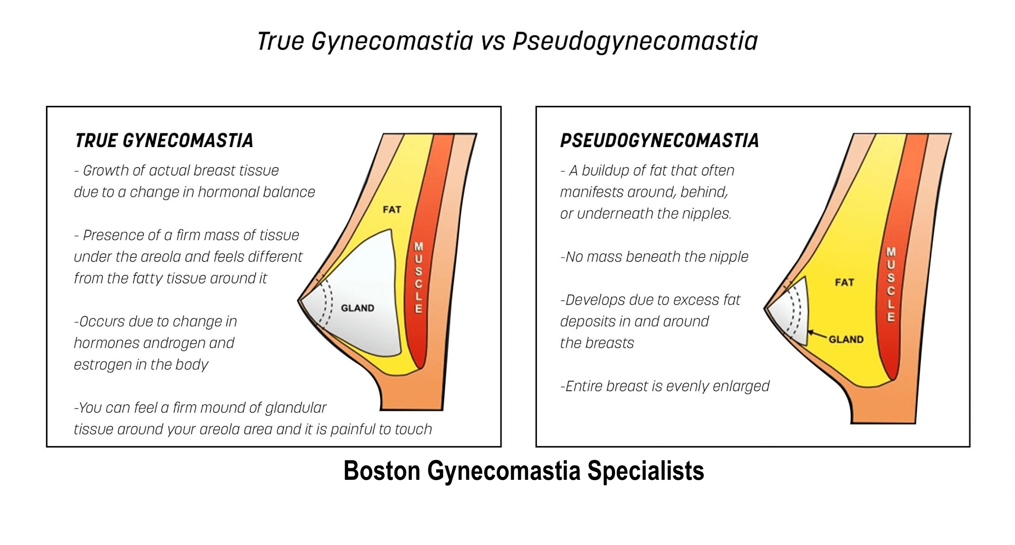 pseudoGynecomastia