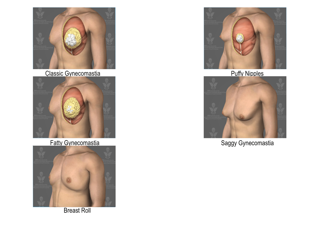 Gynecomastia components