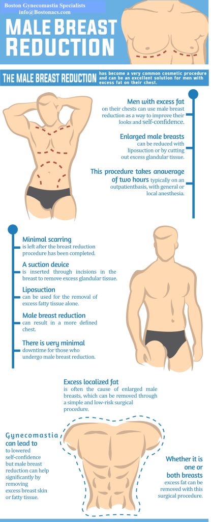 Gynecomastia procedure infographic