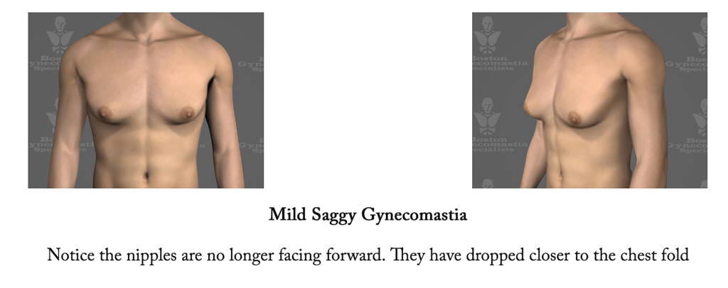 mild saggy Gynecomastia