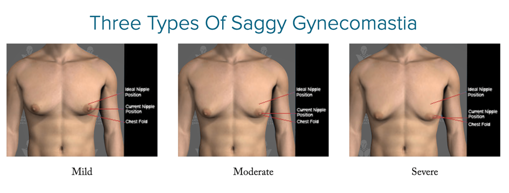 Saggy Gynecomastia