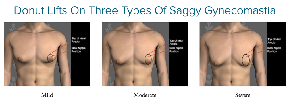 treatment of saggy Gynecomastia