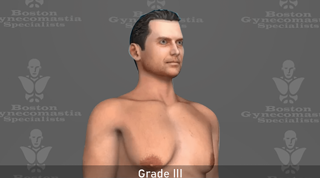 grade III Gynecomastia