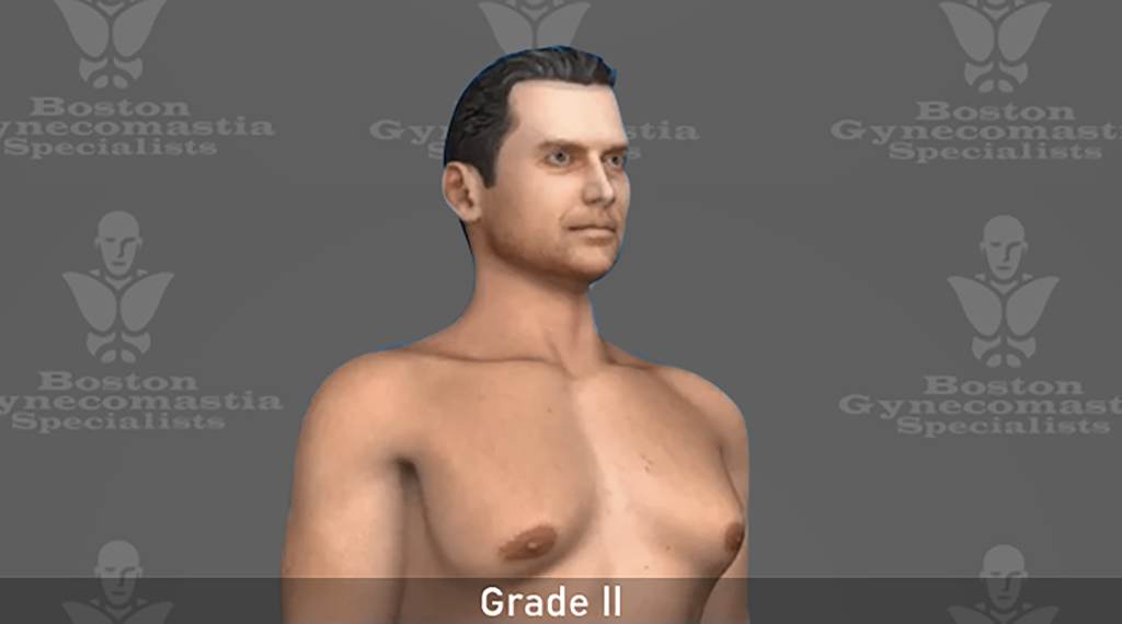 grade II Gynecomastia