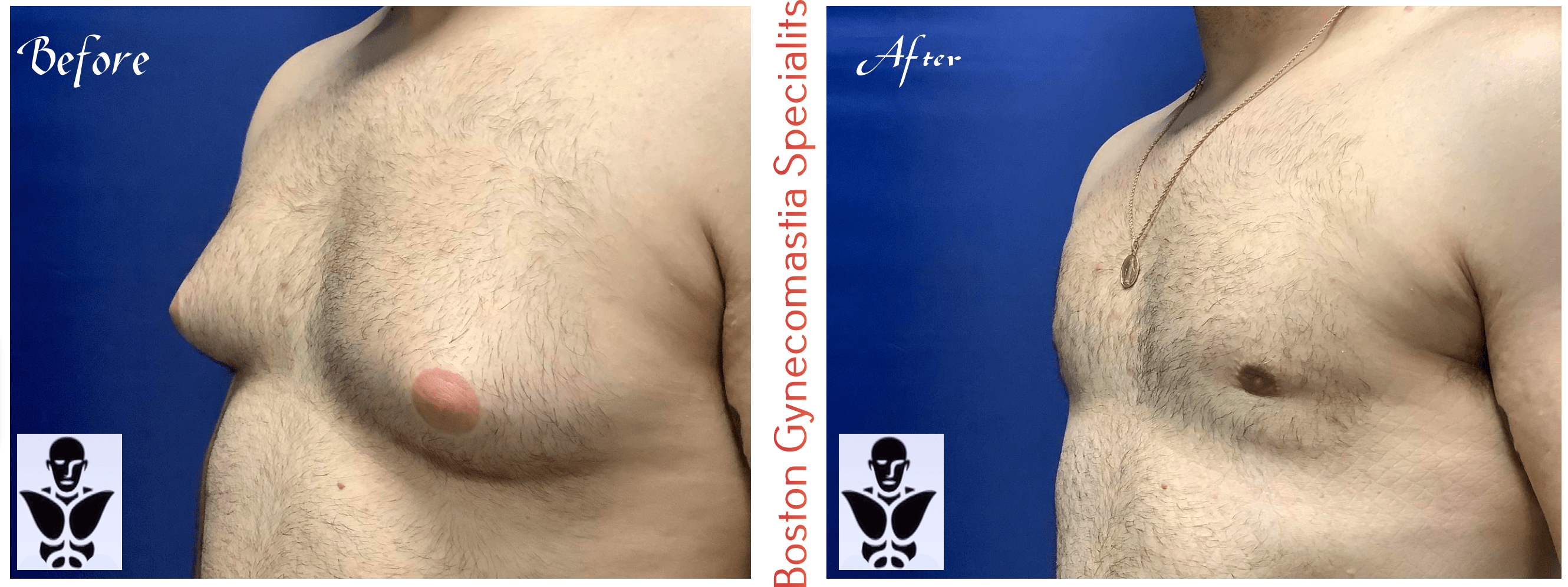 Boston gynecomastia specialists GYNO BA 10