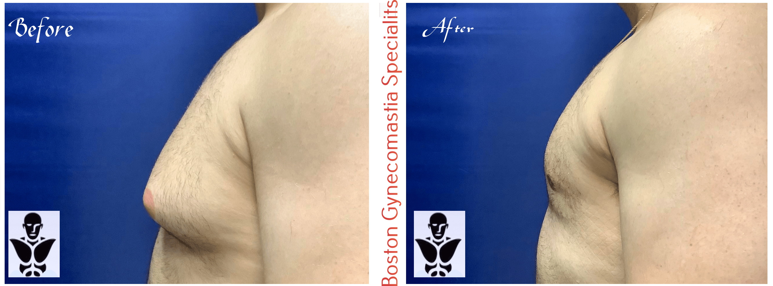 Boston gynecomastia specialists GYNO BA 11