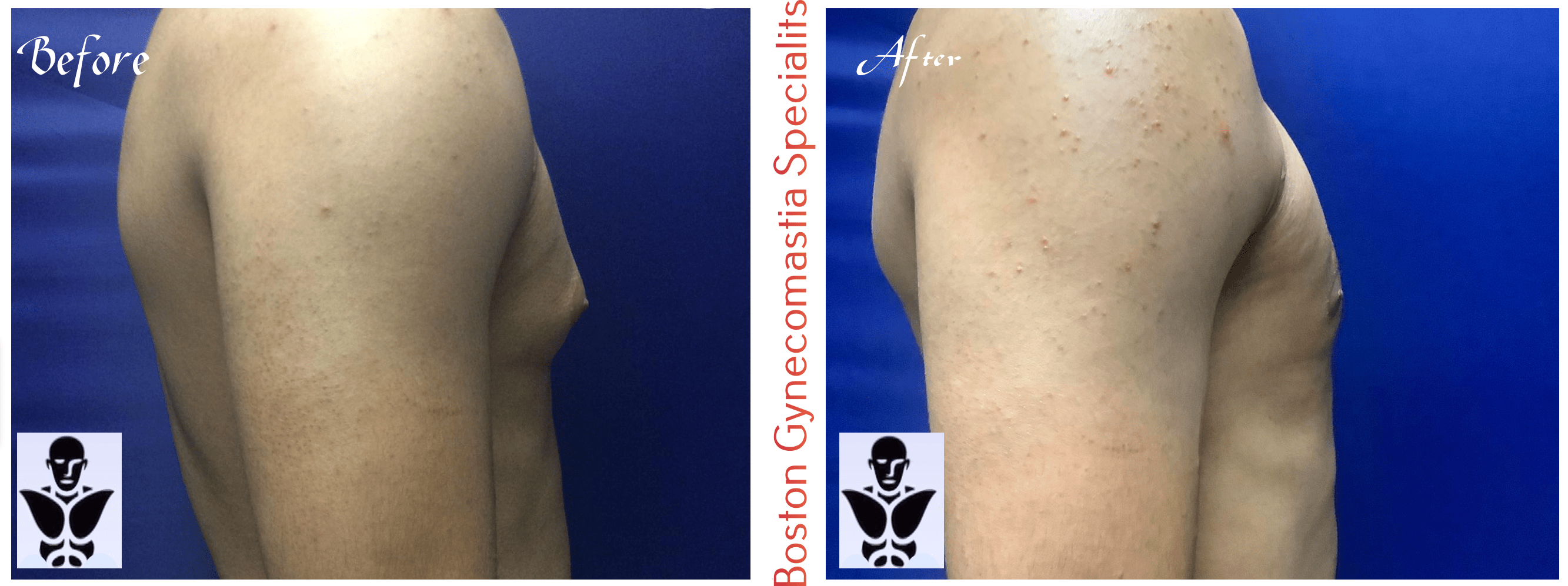 Boston gynecomastia specialists GYNO BA 16