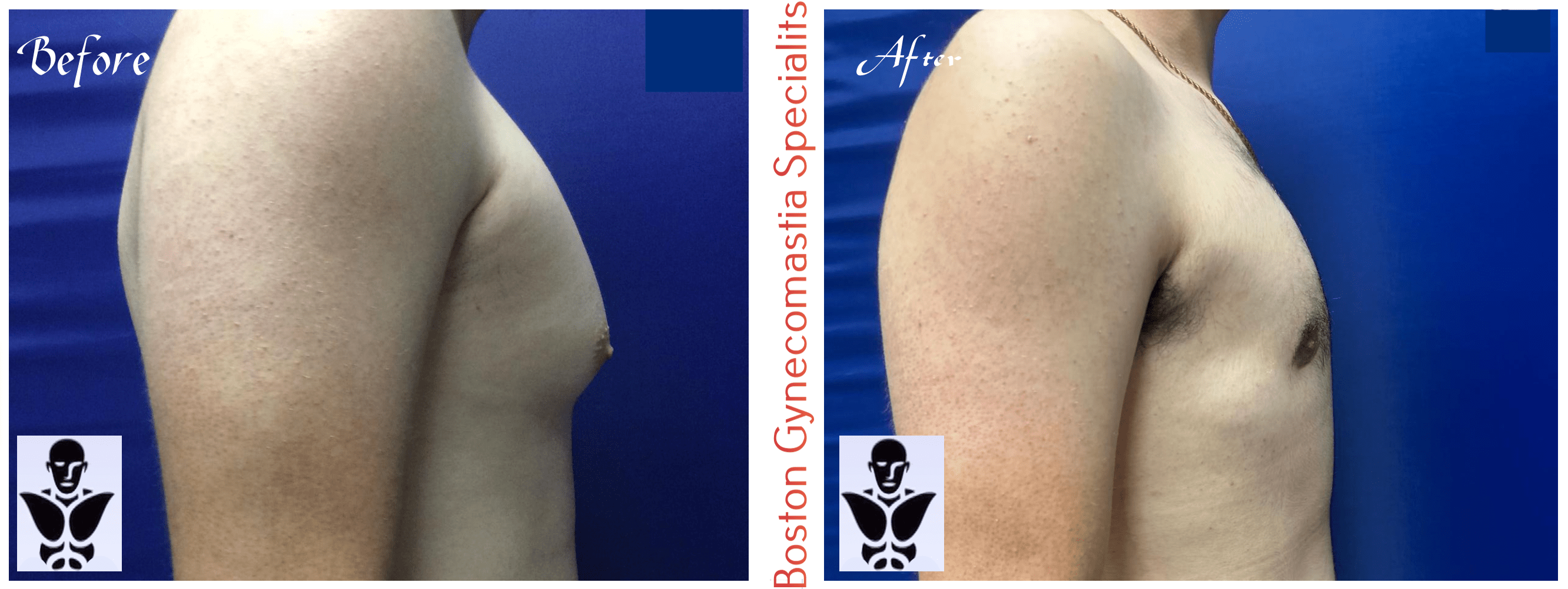 Boston gynecomastia specialists GYNO BA 17