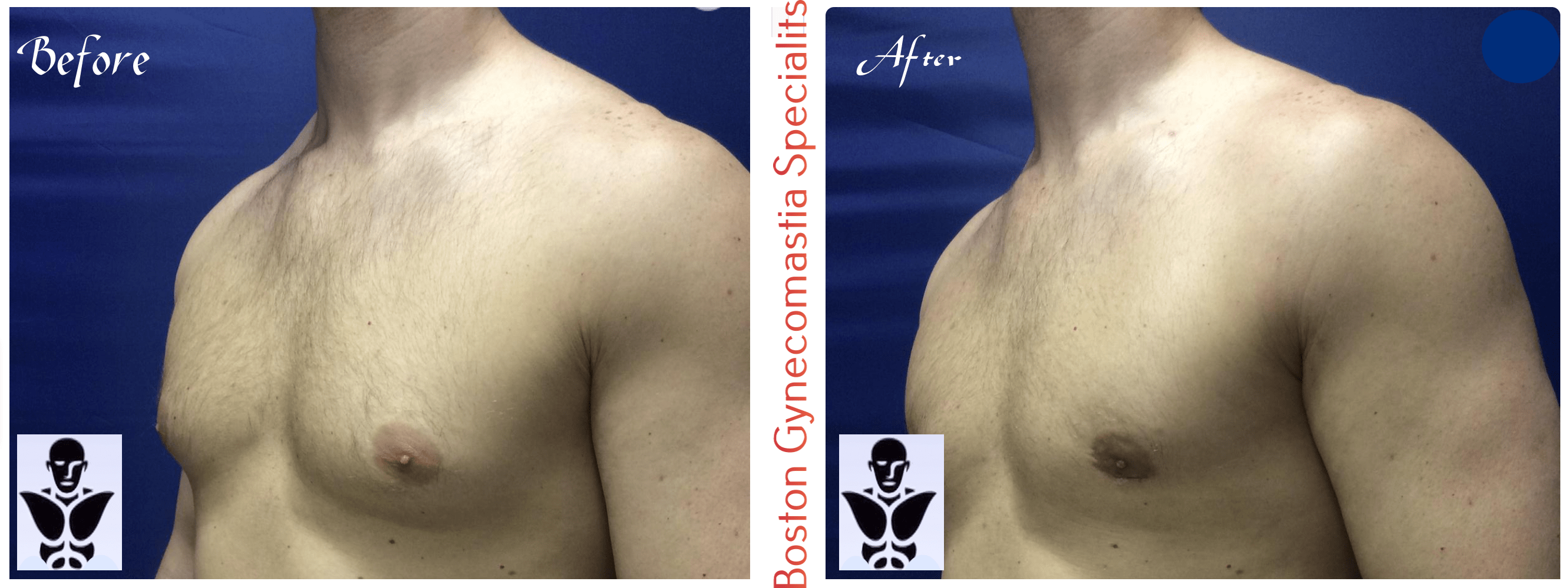 Boston gynecomastia specialists GYNO BA 18