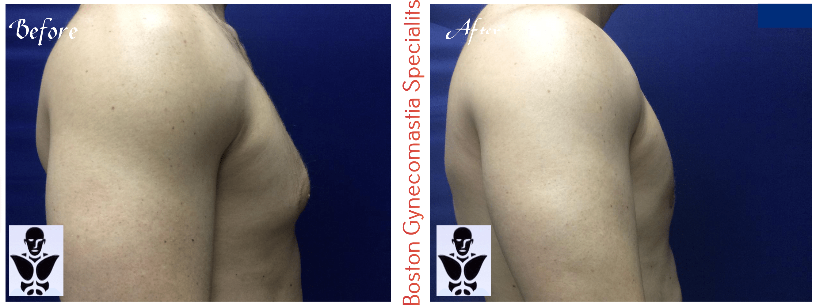 Boston gynecomastia specialists GYNO BA 20