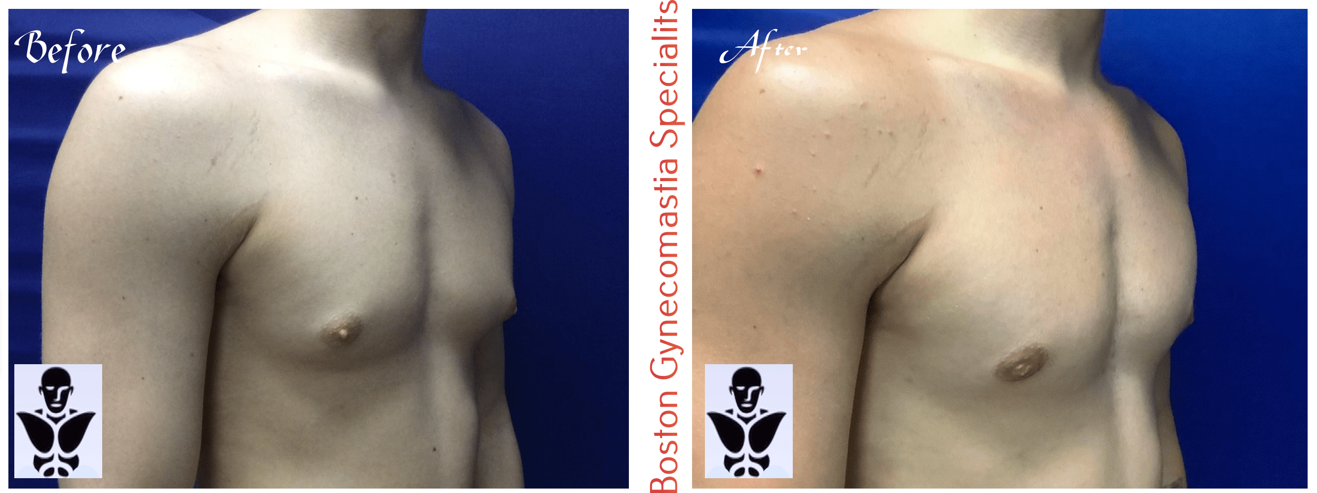 Boston gynecomastia specialists GYNO BA 28