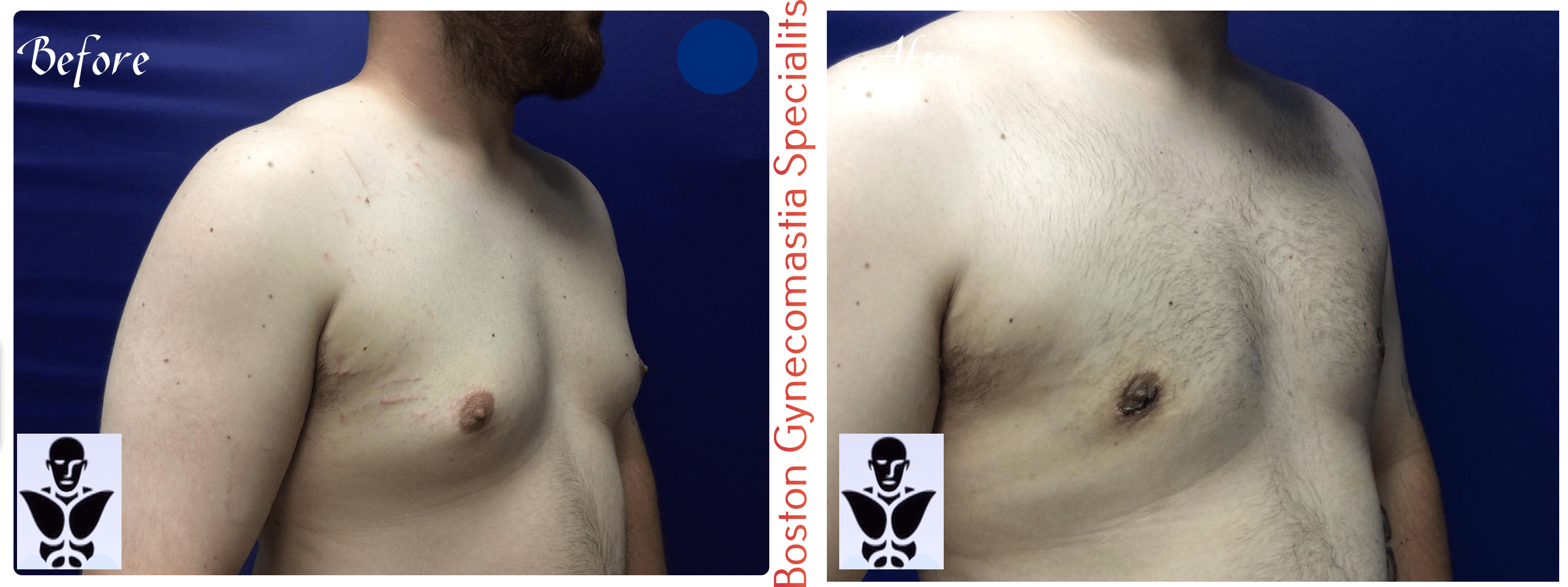 Boston gynecomastia specialists GYNO BA 37