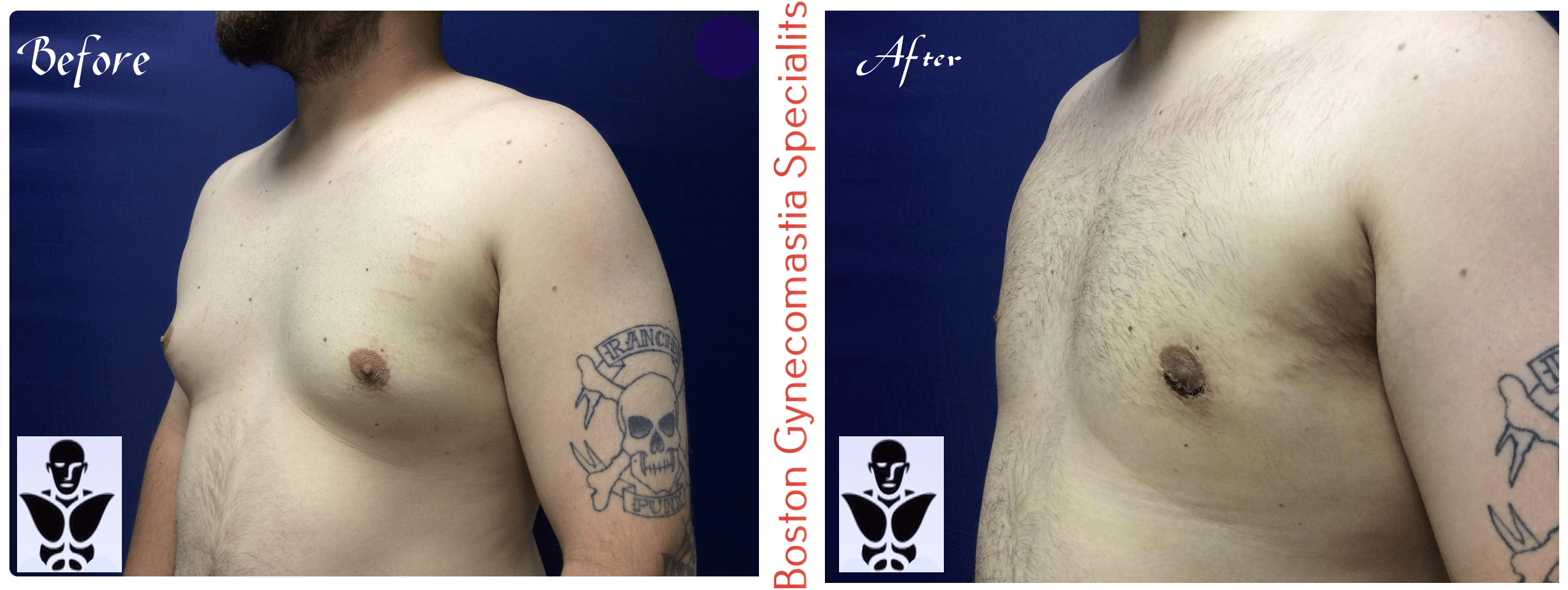 Boston gynecomastia specialists GYNO BA 38