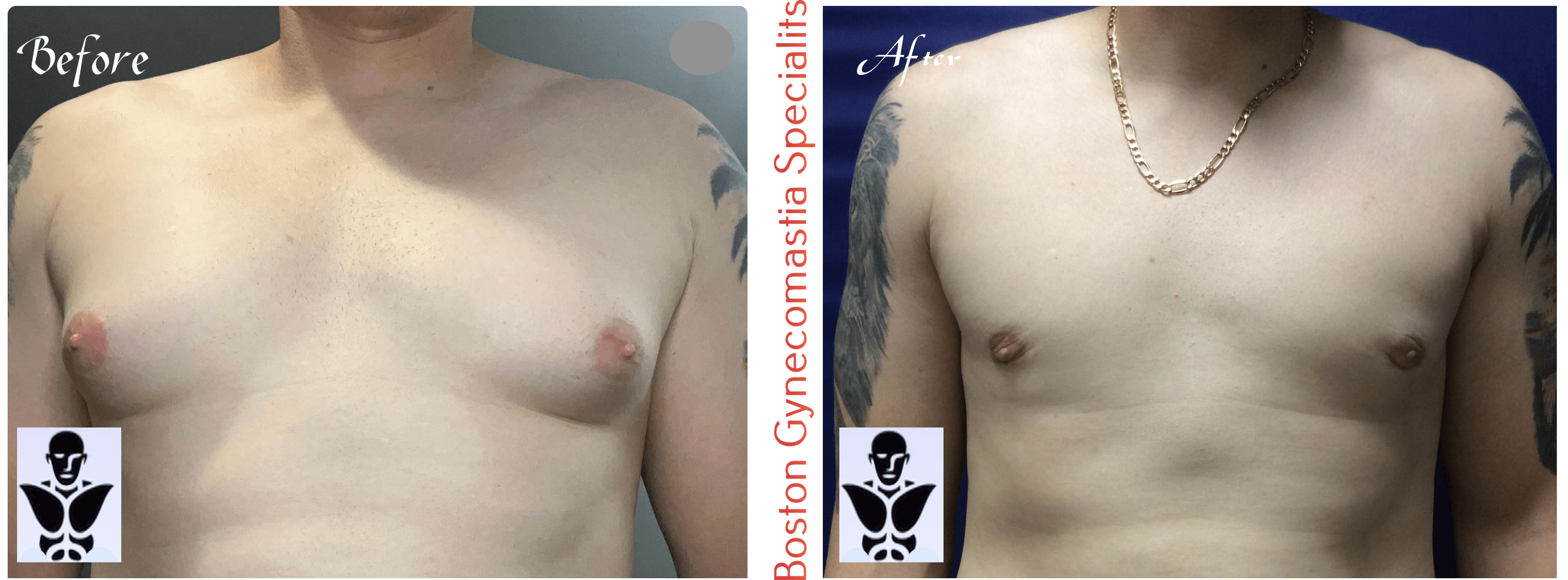 Boston gynecomastia specialists GYNO BA 4