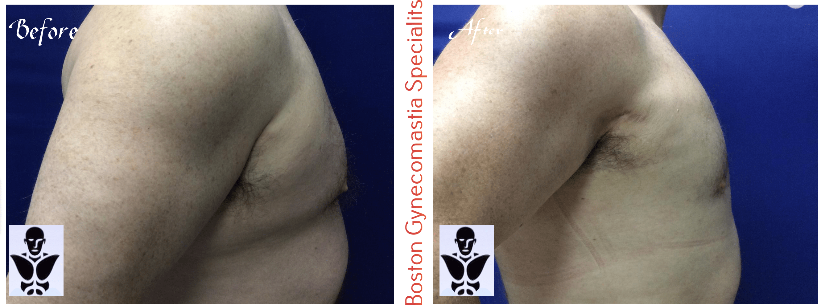 Boston gynecomastia specialists GYNO BA 40