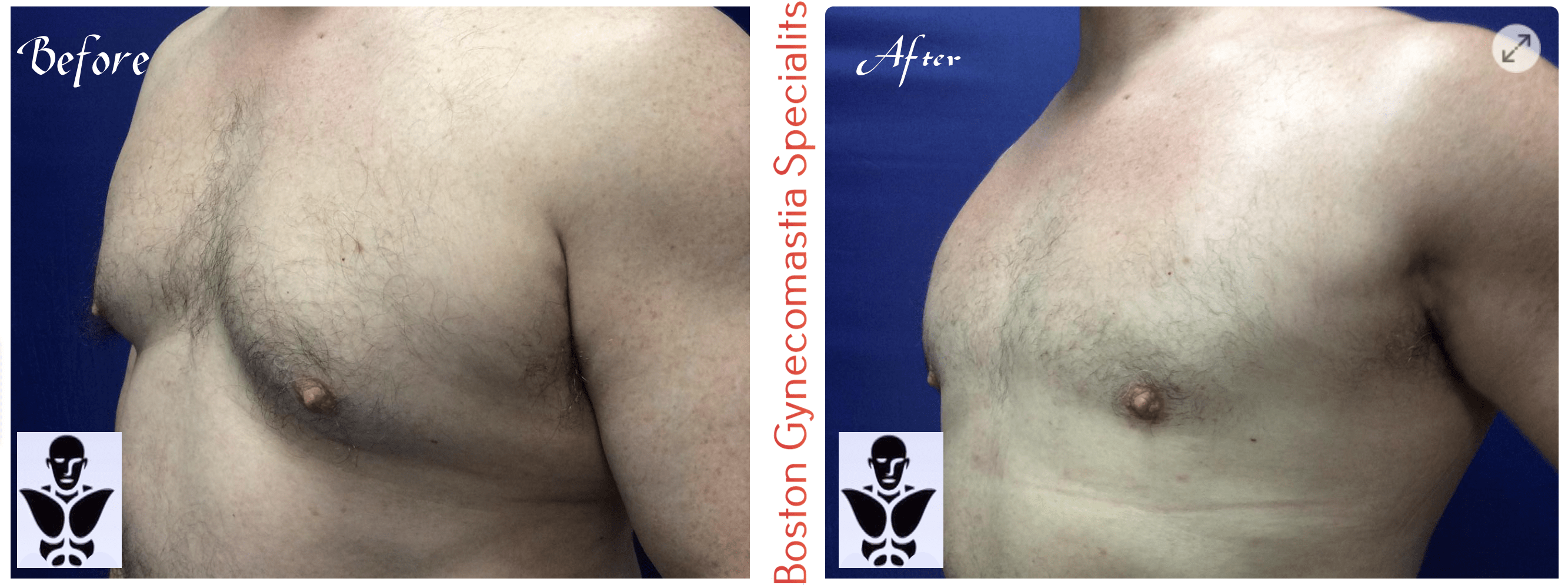 Boston gynecomastia specialists GYNO BA 41