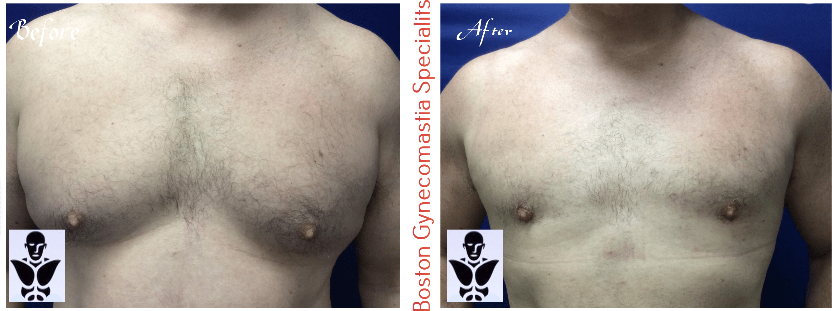 Boston gynecomastia specialists GYNO BA 42