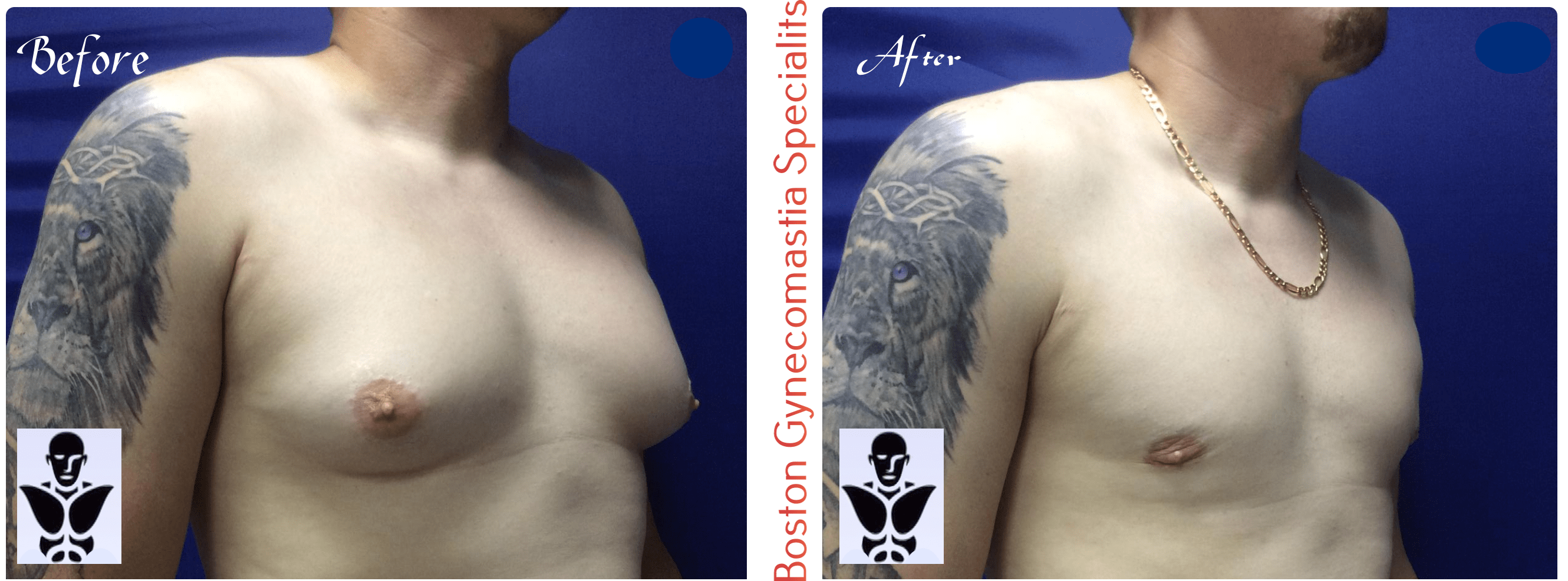 Boston gynecomastia specialists GYNO BA 5