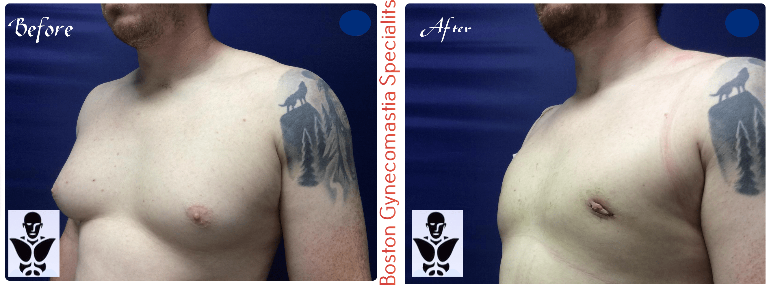 Boston gynecomastia specialists GYNO BA 6