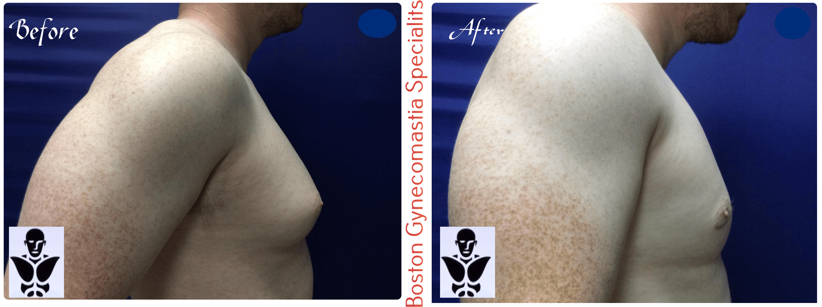 Boston gynecomastia specialists GYNO BA 7