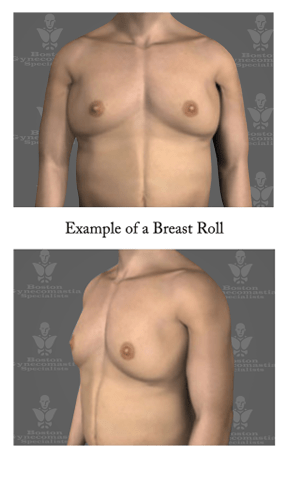 Gynecomastia