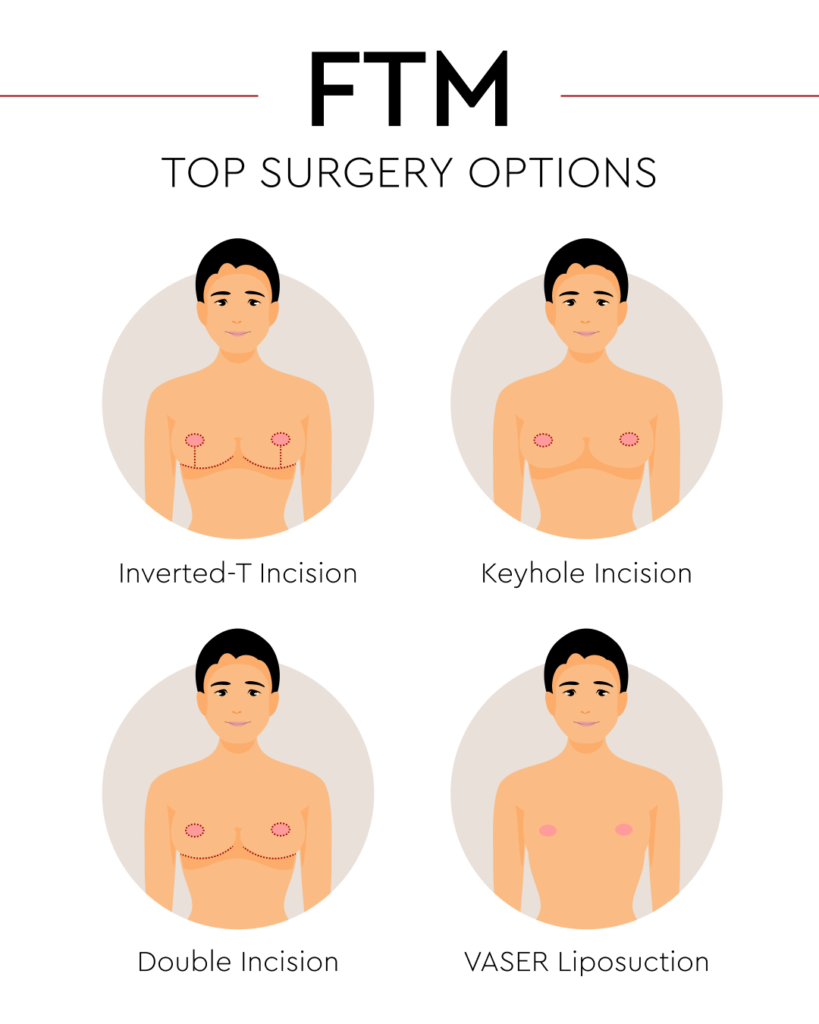 Boston gynecomastia specialists Bostonl infographic ftm top surgery options 231221