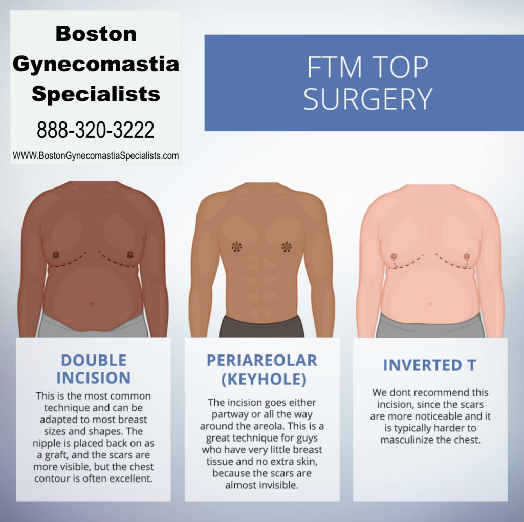 Trans FTM Top Surgery in Boston