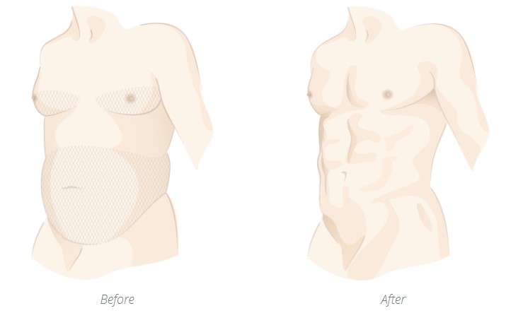 Boston gynecomastia specialists Ishoo liposuction for men