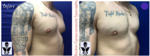 body builder gynecomastia surgery result