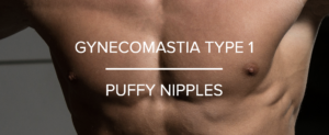 Boston gynecomastia specialists TYPE 1 GYNO PUFFY NIPPLES