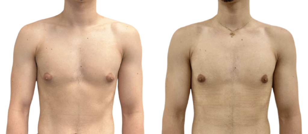 Boston gynecomastia specialists puffy nipples before and after