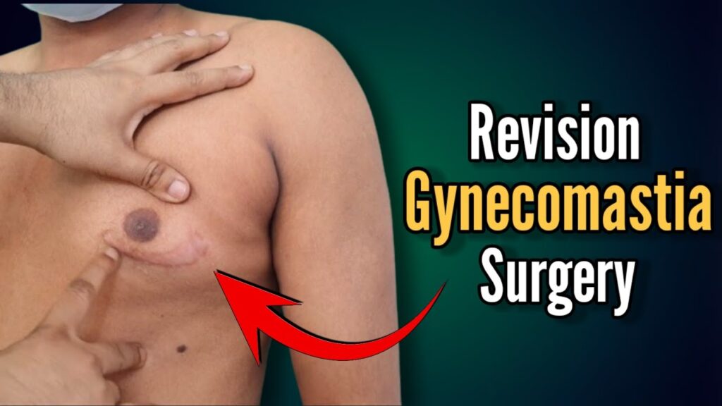 Boston revision gynecomastia surgery