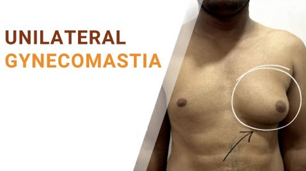 Boston gynecomastia specialists unilateral gyno