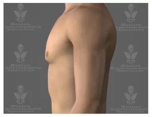 lateral view Gynecomastia stage I