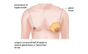 Boston gynecomastia specialists How Gynecomastia Glandular Tissue Removal is Done Dr Edwin Ishoo 1234