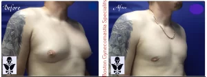 ADULT MALE BREAST REDUCTION RESULT