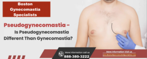 Pseudogynecomastia in Boston