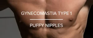 TYPE 1 GYNO PUFFY NIPPLES